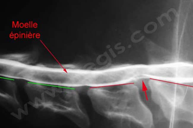 Myélographie sur un chien atteint d’un syndrome de wobbler et mettant en évidence une importante compression de la moelle épinière (flèche) due aux déplacements de certaines vertèbres cervicales (trait rouges)