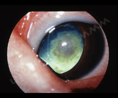 Microphtalmie congénitale bilatérale, associée à une cataracte congénitale chez un jeune chien Dogue argentin. - CHV Fregis