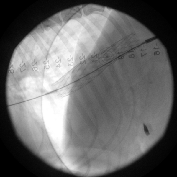 contrôle fluoroscopique après déploiement du stent de la veine cave caudale