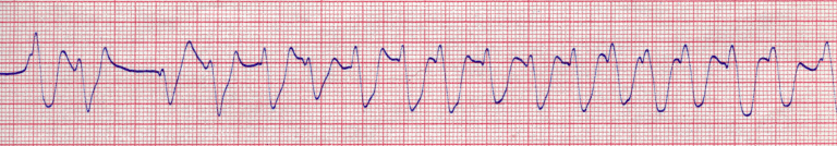 Électrocardiogramme : la fibrillation ventriculaire est un grave trouble du rythme cardiaque qui évolue vite vers la mort.