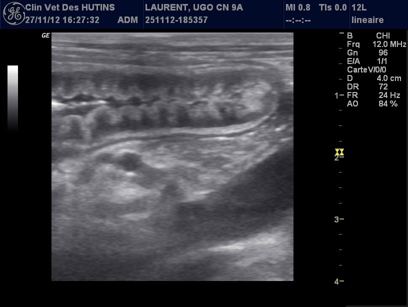 Examen endoscopique Hypertrophie sévère et diffuse de la muqueuse gastrique du fundus à l’antre pylorique. Nombreuses ulcérations superficielles.
