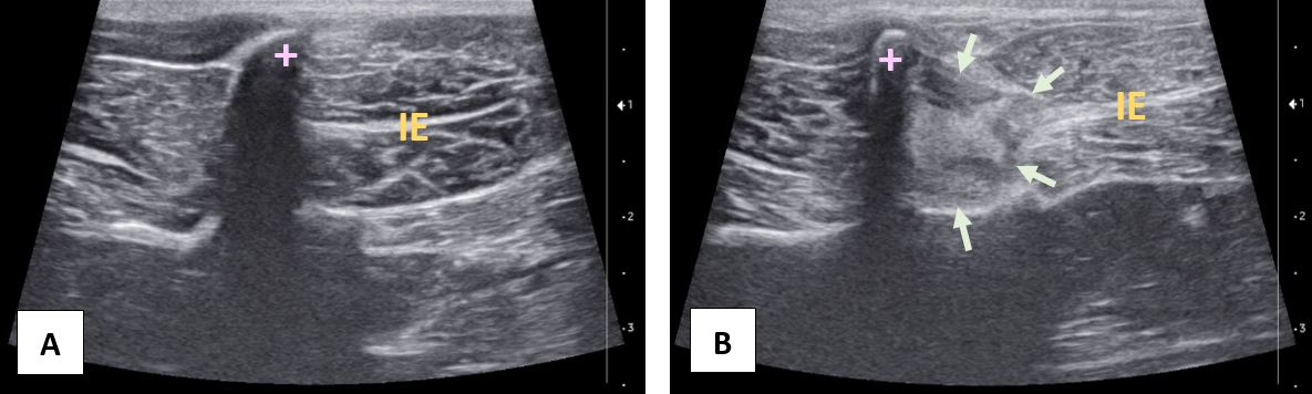 Images échographiques du muscle infra-épineux, noté « IE » (A : normal, B : contracturé). Les flèches délimitent la zone de fibrose. La croix rose indique l’acromion.