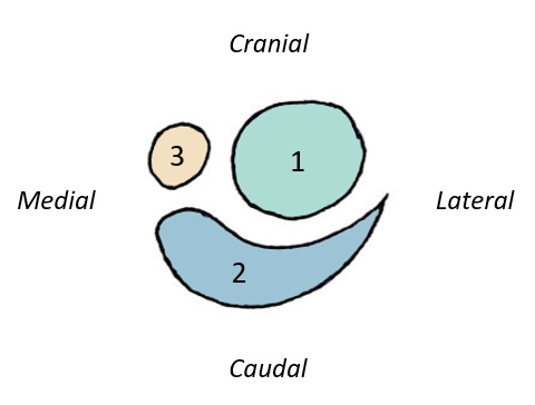 Figure 2 : schématisation en coupe transversale des différents composants du tendon calcanéen commun. 1 : tendon gastrocnémien, 2 : tendon fléchisseur superficiel, 3 : tendon accessoire.