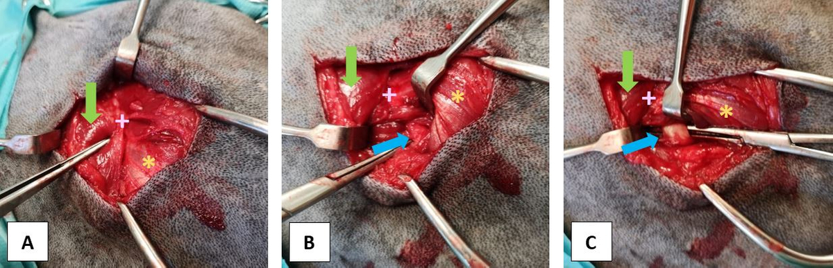 Photographies peropératoires de la procédure chirurgicale dans l’ordre chronologique (A : à l’ouverture, B : après réclinaison du muscle deltoïde, C : après dissection circonférentielle du tendon du muscle infraépineux). La flèche verte indique le muscle brachio-céphalique. La croix rose indique l’acromion. L’étoile orange indique le muscle deltoïde (chef acromien). La flèche bleue indique le tendon du muscle infraépineux.