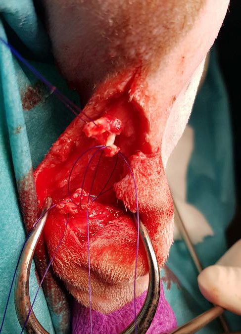 Figure 5 : photographie du tendon calcanéen commun sectionné traité par ténorraphie avec un triple nœud de poulie.