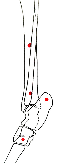 Figure 7 : schématisation (droite)du tarse en vue latérale après ténorraphie et pose d’un fixateur externe en extension maximale du tarse. Les points rouges indiquent les différents points d’ancrage des broches du fixateur externe