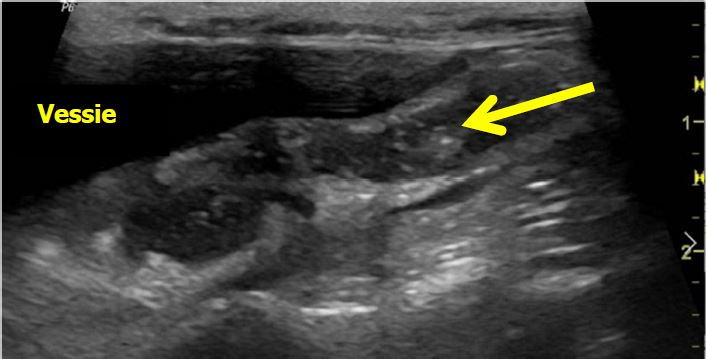 Photo 4 : Dilatation importante de l’uretère gauche distal (6 mm) avec un contenu échogène. (flèche jaune)