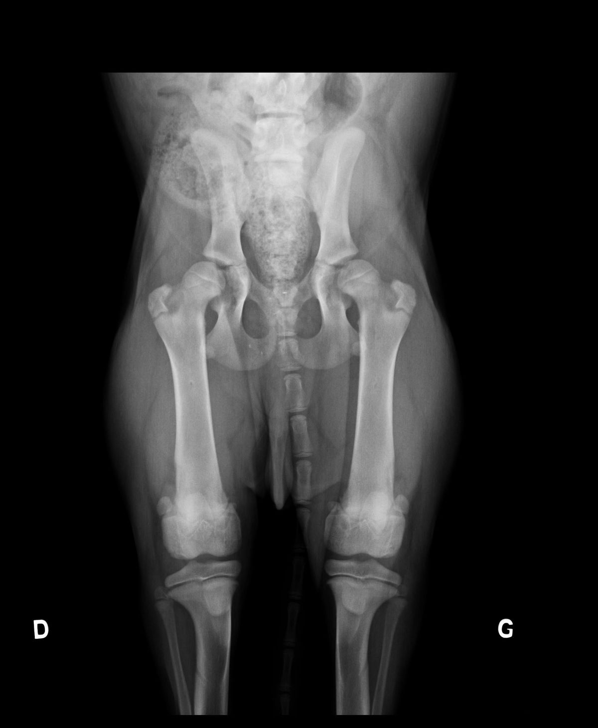 Radiograpie de dépistage précoce de dysplasie en position standard (décubitus dorsal, hanches en extension)