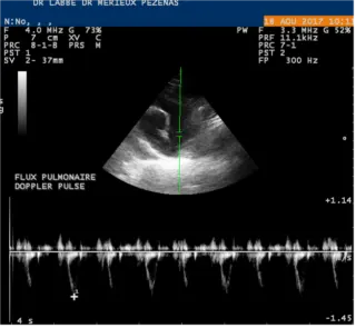 Flux pulmonaire – Doppler pulsé