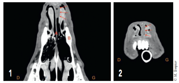 Carcinome Epidermoide De L Extremite Rostrale Du Septum Nasal Cordeliers