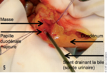 Obstruction biliaire extra-hpatique | CHV Cordeliers