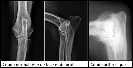 Aspect radiographique normal d'un coude vs  coude arthrosique