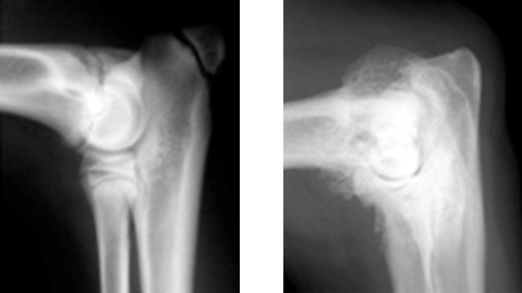 Évolution arthrosique