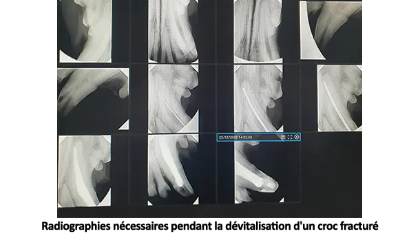 Radiographies croc fracture