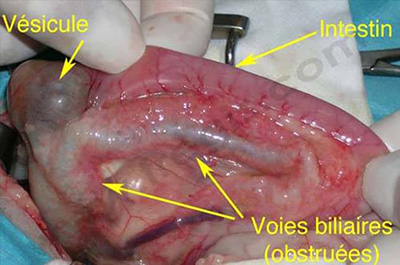 Obstruction des voies biliaires