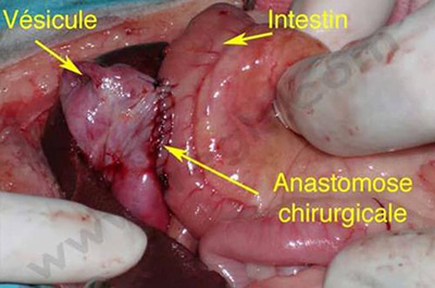 Chirurgie des voies bilaires