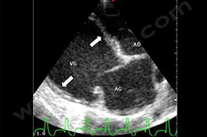 Echocardiographie sur un Schnauzer de 2 ans atteint d'une CMD avec insuffisance cardiaque grave