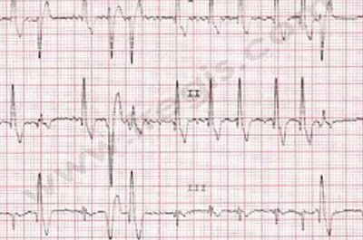 Electrocardiogramme animal atteint CMD