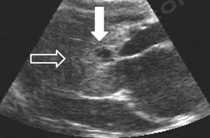 Echographie d'un chat présentant une forme grave de CMH, d'origine indéterminée