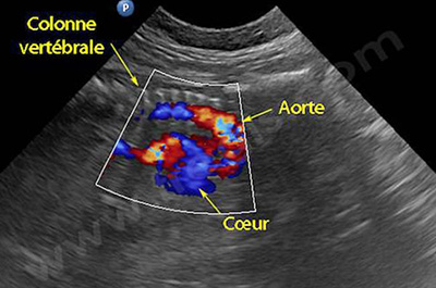 Echo: Le Doppler couleur permet d’identifier le cœur et les gros vaisseaux