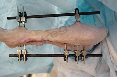 Fracture du tibia réparée par un fixateur externe