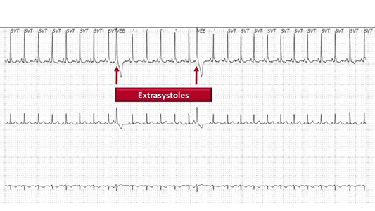 Résultat d’un Holter chez un chat montrant des arythmies appelées extrasystoles