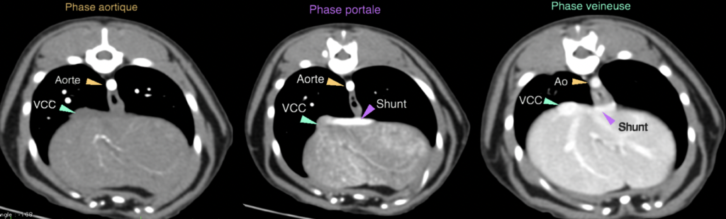 Exemple de shunt porto-systémique