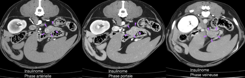 Insulinome en trois phases