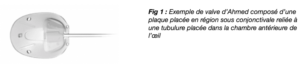 Fig.1: exemple de valve d'Ahmed