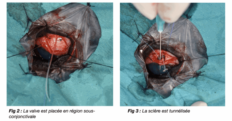 La valve est placée en région sous-conjonctivale, la scière est tunnéliste