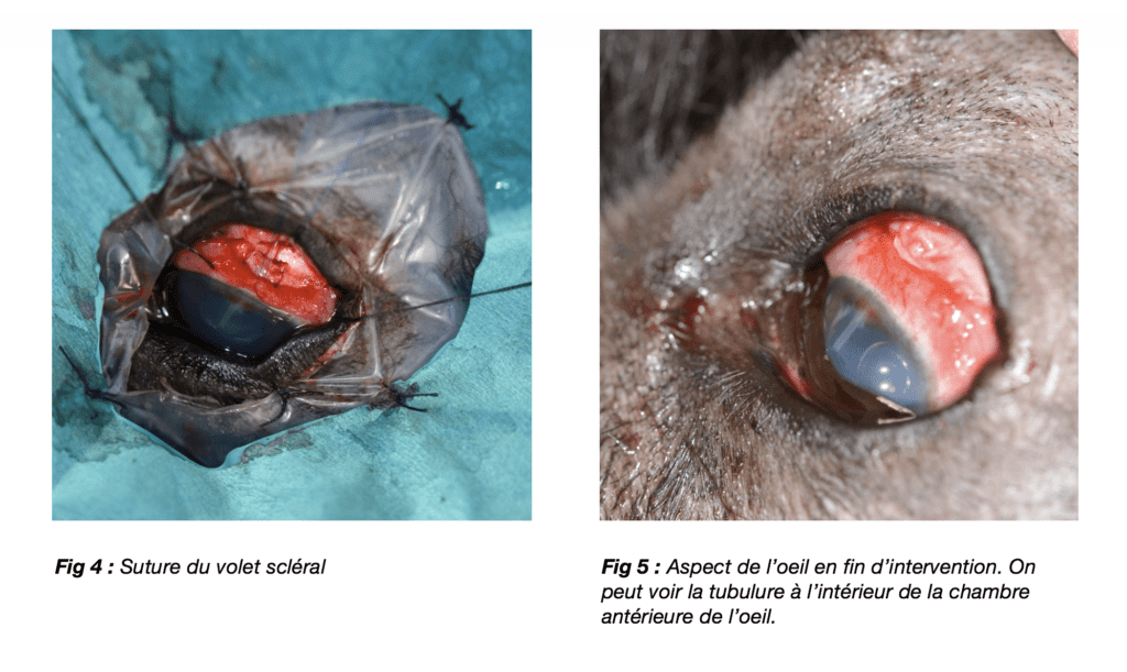 Suture du volet scléral et Aspect du l'oeil en fin d'intervention. On peut voir la tubulure à l'intérieur de la chambre antérieure de l'oeil.