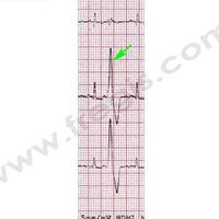 1. Extrasystole ventriculaire chez un chien atteint de cardiomyopathie arythmogène du ventricule droit (ARVC)