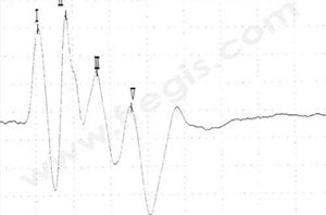 Potentiel évoqué auditif chez un chien normal. Quatre pics sont présents