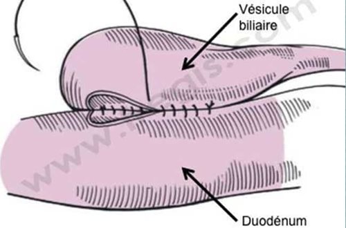 Chirurgie des voies bilaires chez le chien (cholécysto-entérostomie)