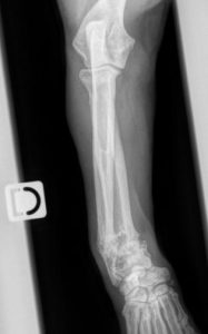 Radiographie d’un chien chondrodystrophique avec un excès de la déformation entraînant un radius curvus nécessitant une correction chirurgicale pour éviter le stress accentué au niveau du coude et du carpe.