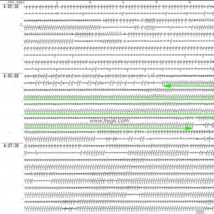 Enregistrement Holter chez un chien présentant des périodes nombreuses et longues d’arythmie (tachycardie ventriculaire). L’évolution vers une mort subite est possible