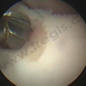 Chirurgie assistée par arthroscopie d'une FPC (fragmentation de processus coronoïde) chez un chien