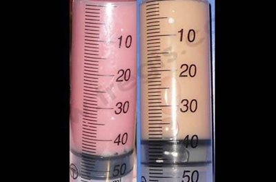 Aspect de liquide pleural chyleux (à gauche) et purulent (à droite).