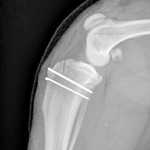 Radiographie post-opératoires - chirurgie de luxation de la rotule