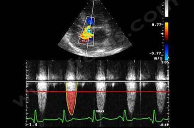 2. Photo 5 : Echocardiographie et Doppler continu chez un chien Golden retriever atteint d’une grave sténose aortique. La vitesse du sang au niveau de l’aorte (trait jaune) est très anormalement augmentée. La courbe ne devrait pas dépasser le trait rouge​