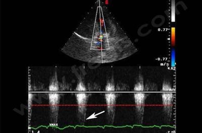 Echocardiographie avec Doppler continu sur un chien de race Bulldog anglais atteint d’une grave sténose pulmonaire. Le rétrécissement à la base du tronc pulmonaire est responsable d’une très importante augmentation de la vitesse d’éjection du sang, représentée par le cône blanc (flèche) qui ne devrait dépasser la ligne rouge pointillée.