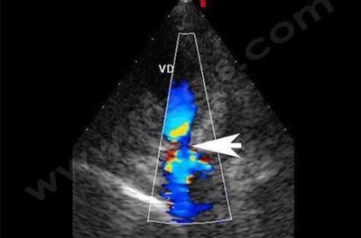 Echocardiographie avec Doppler couleur sur un chien de race Chihuahua atteint d’une sténose pulmonaire. La colonne de sang éjectée du ventricule droit (VD) et matérialisée par la couleur est brutalement resserrée au niveau de la sténose. La sténose est due à une malformation de la valve pulmonaire, située entre le ventricule droit et le tronc pulmonaire.