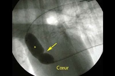 Traitement d’une sténose pulmonaire chez un chien de race Terre-Neuve. Un ballonnet (étoile) est introduit depuis le vaisseau d’une patte arrière jusque dans le cœur au niveau de la sténose (flèche) qui le déforme. Il est alors fortement gonflé pour « déchirer » la sténose.