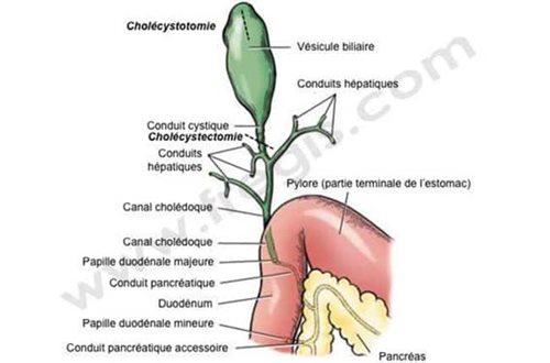 Topographie des voies bilaires. Illustration de la cholecystotomie et cholecystectomie.