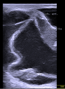 Traumatisme contondant et perforant du globe oculaire droit CHV Fregis