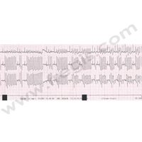 2. Tachycardie ventriculaire chez un chien atteint cardiomyopathie arythmogène du ventricule droit (ARVC)