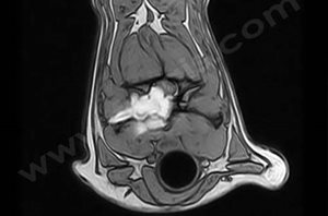 Résonnance magnétique d'une tumeur vertébrale (masse blanche) au niveau du cou