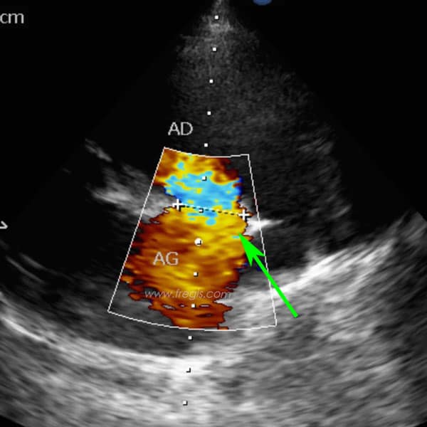 Echographie cardiaque d’une communication inter-atriale (CIA) de grande taille chez un chien