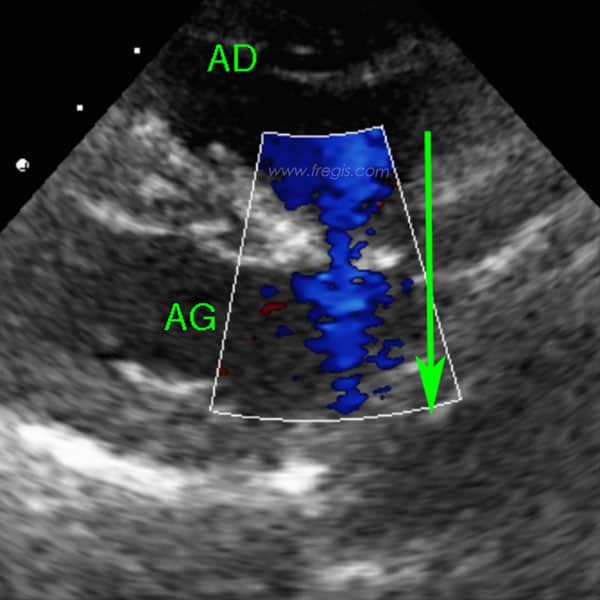 Echographie cardiaque et Doppler couleur d’une communication inter-atriale (CIA) chez un chien