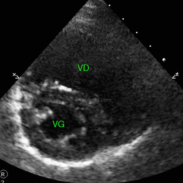 Echographie cardiaque d’une communication inter-atriale (CIA) chez un chien avec une augmentation importante du ventricule droit